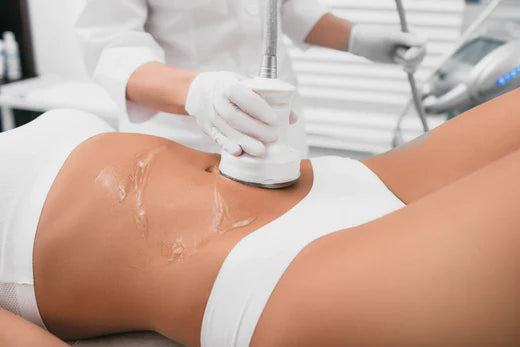 Lipocavitation (Ultrasons, Radiofréquence)